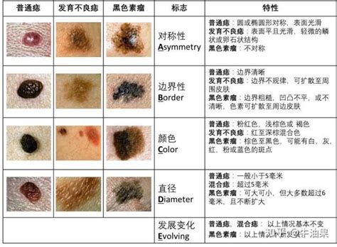 黑色痣|痣是什麼？會變成黑色素瘤？7種一定要除的痣